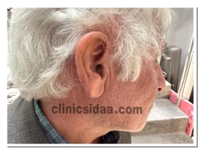 ساخت پروتز گوش و گوش سیلیکونی