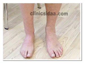 انواع پروتز پا