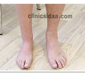 انواع پروتز پا