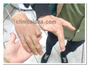 قیمت پروتز انگشت سیلیکونی