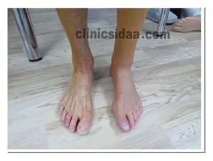 پروتز پای سیلیکونی