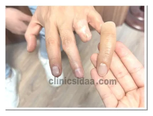  انواع پروتز انگشت دست