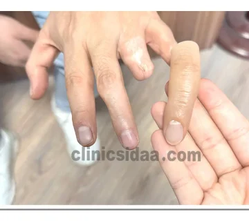  انواع پروتز انگشت دست