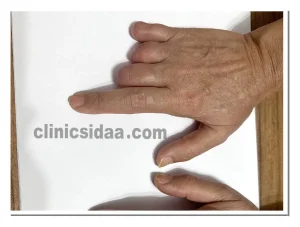 قیمت پروتز انگشت دست