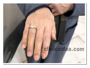 قیمت پروتز انگشت سیلیکونی