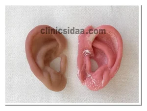 ساخت پروتز گوش و گوش سیلیکونی