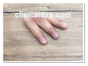 پروتزهای انگشت سیلیکونی