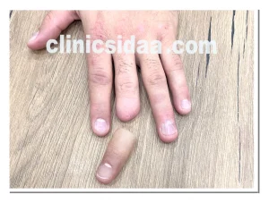 پروتزهای انگشت سیلیکونی