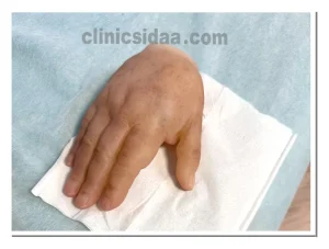 پروتز دست سیلیکونی