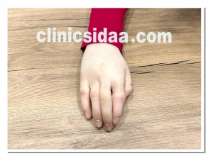 پروتزهای انگشت سیلیکونی