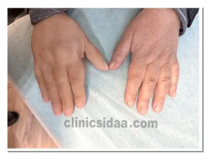 بهترین مرکز پروتز دست