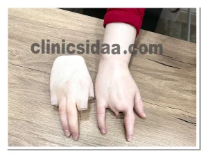 لیست قیمت پروتز انگشت دست