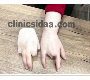 لیست قیمت پروتز انگشت دست