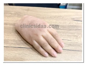 پروتز دست سیلیکونی
