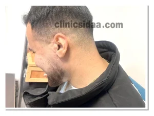 ساخت پروتز گوش و گوش سیلیکونی