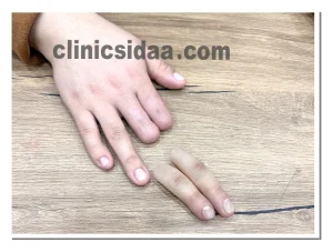 مراقبت از پروتز انگشت