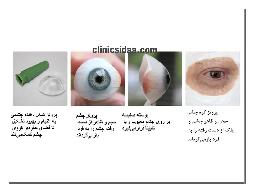 انواع چشم مصنوعی یا پروتز چشم