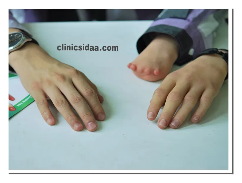 پروتز دست سیلیکونی 8 انواع پروتز دست