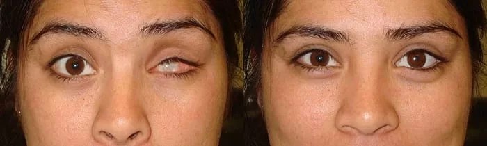 مزایای چشم مصنوعی