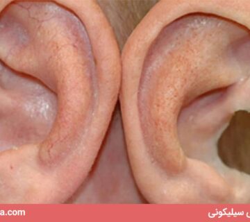 پروتز گوش و گوش سیلیکونی با ضمانت یکساله اقساطی + کیفیت عالی