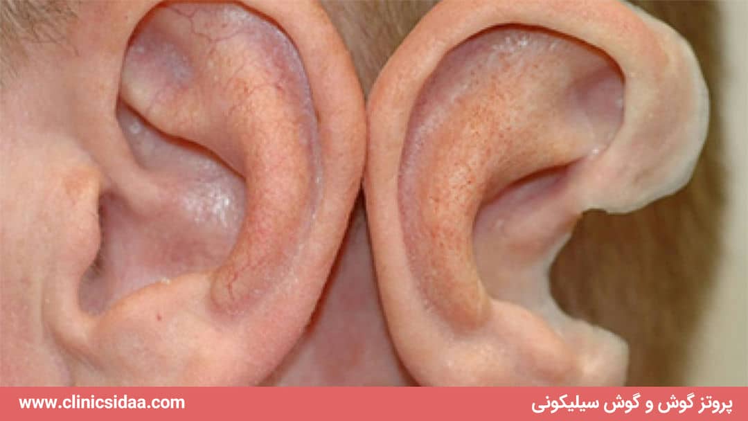 ساخت پروتز گوش و گوش سیلیکونی 1 پروتز گوش و گوش سیلیکونی با ضمانت یکساله اقساطی + کیفیت عالی