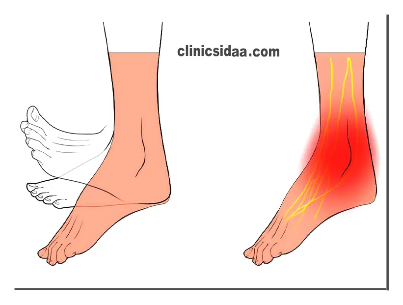 تشخیص افتادگی مچ پا (drop foot)