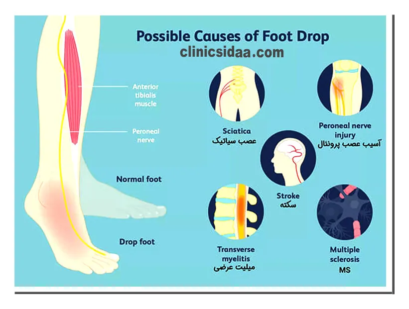 علائم افتادگی مچ پا