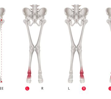 درمان زانوی ضربدری در تمام سنین بدون جراحی | اصلاح پای ضربدری