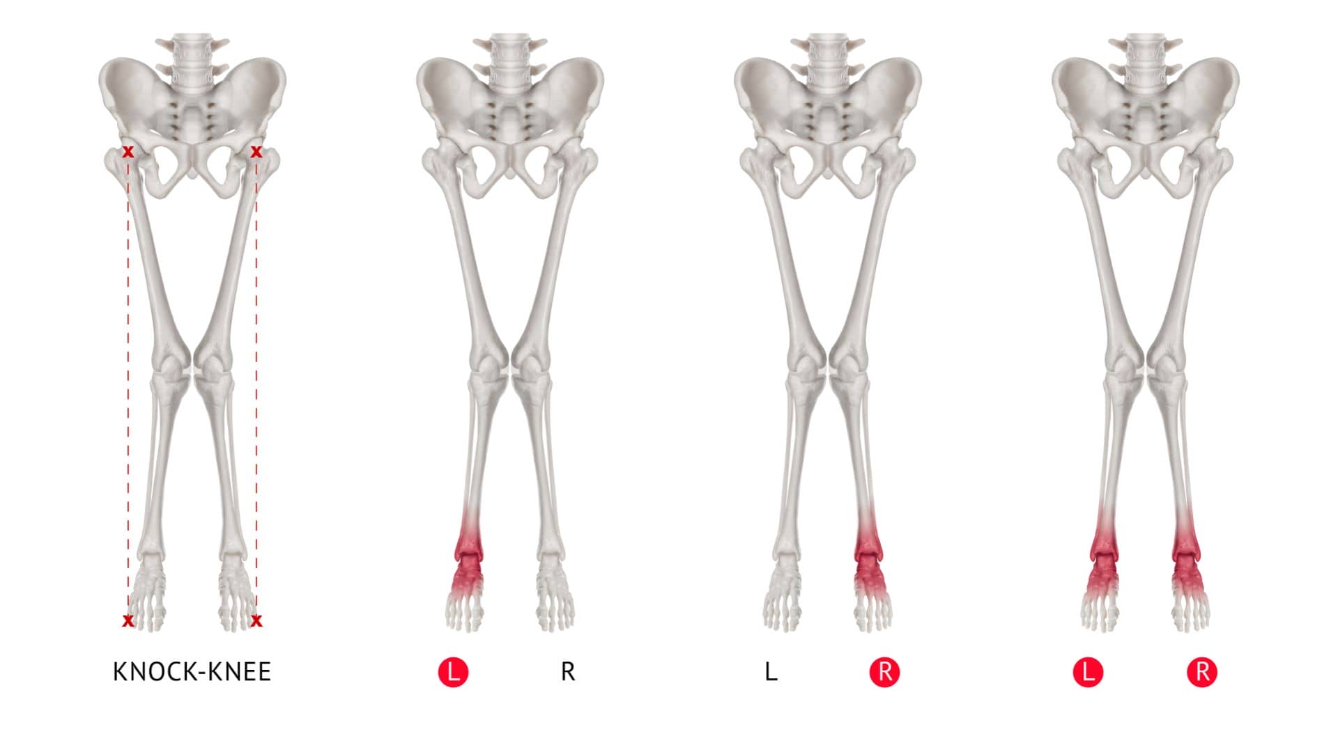 درمان زانوی ضربدری در تمام سنین بدون جراحی: روشهای اصلاح پای ضربدری 1 درمان زانوی ضربدری در تمام سنین بدون جراحی | اصلاح پای ضربدری