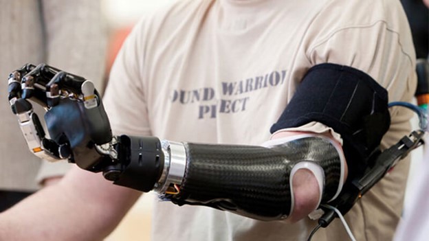 معرفی بهترین پروتزهای دست مکانیکی در کلینیک سیدا با ضمانت یکساله و با کیفیت بالا