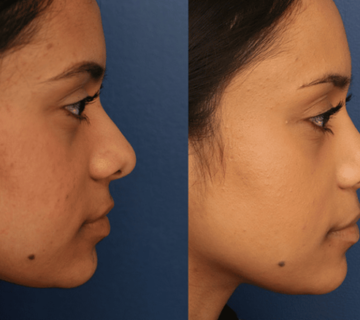 پروتز سیلیکونی بینی با ضمانت یک ساله در کلینیک سیدا