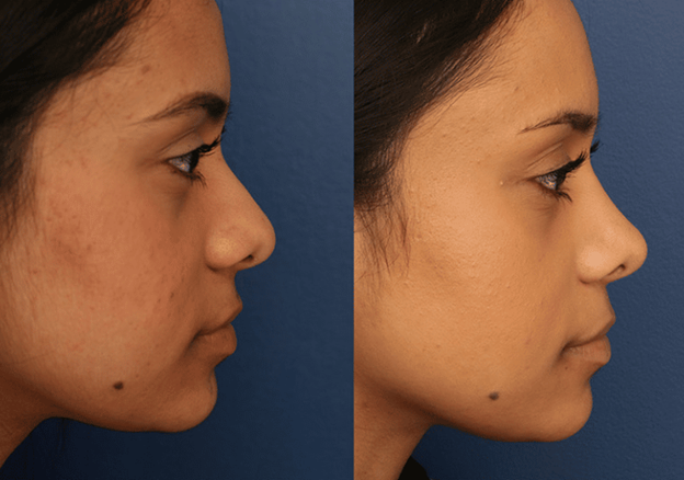 پروتز سیلیکونی بینی با ضمانت یک ساله در کلینیک سیدا