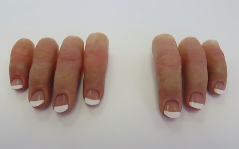 نحوه ساخت پروتز با استفاده از اسکن سه بعدی