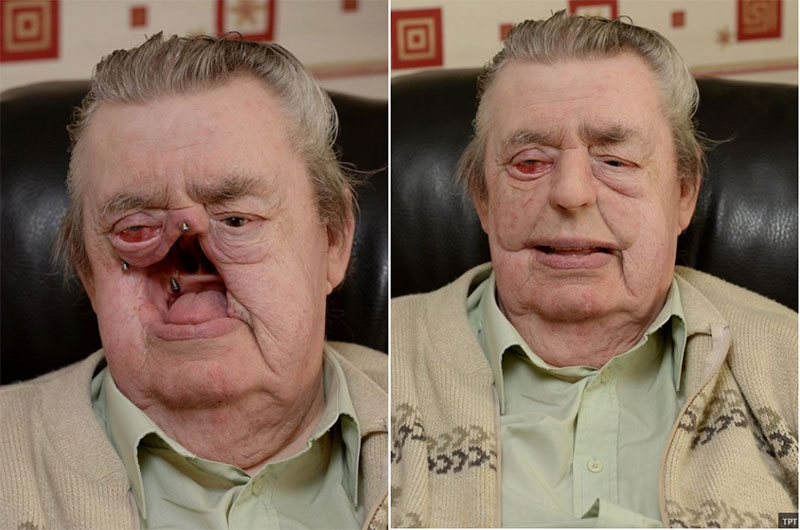 نگران رنگ پروتز نباشید!