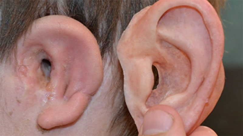 ویژگی‌های پروتز گوش