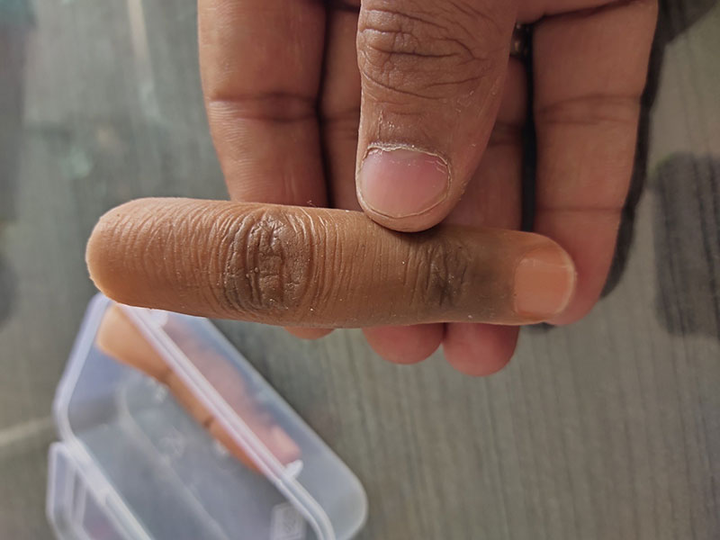 پروتز انگشت دست و پا چیست؟