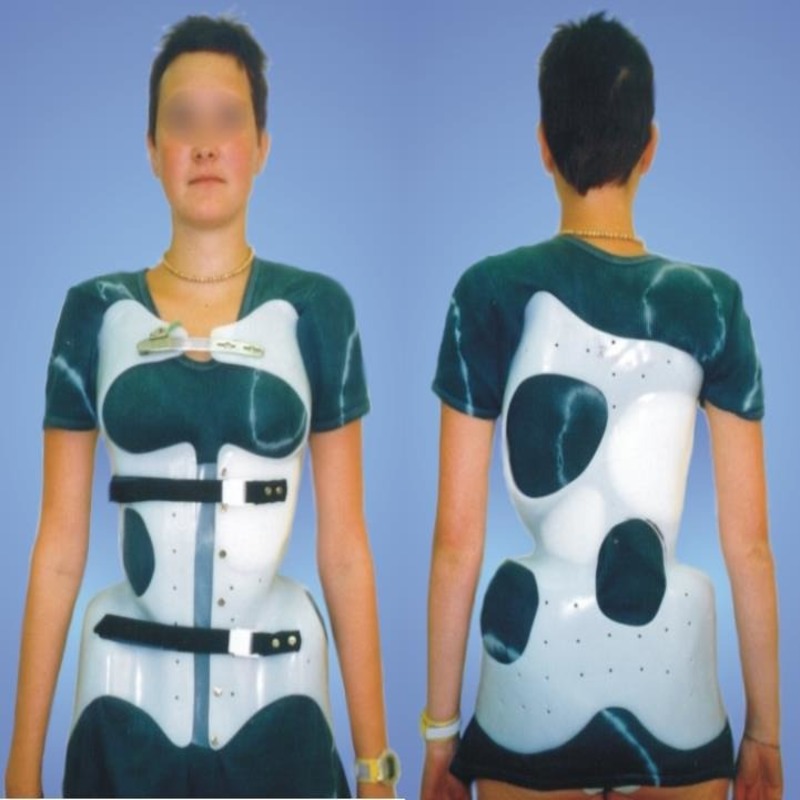 بریس شنو (Cheneau brace) چیست؟ 3 اصلاح اسکولیوز با بریس شنو