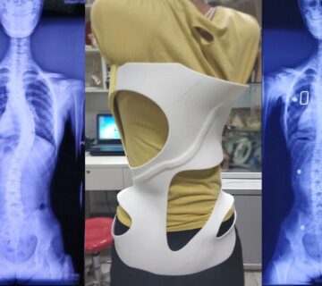 بریس شنو (Cheneau brace) چیست؟ امکان اصلاح اسکولیوز با ان