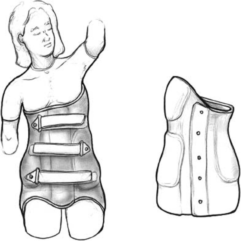 فرق بریس میلواکی با بریس شنو 3 بریس شنو در درمان اسکولیوز