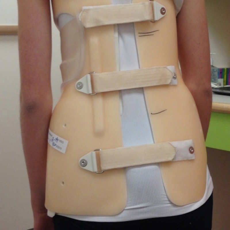 فرق بریس میلواکی با بریس شنو 2 بریس میلواکی در درمان اسکولیوز