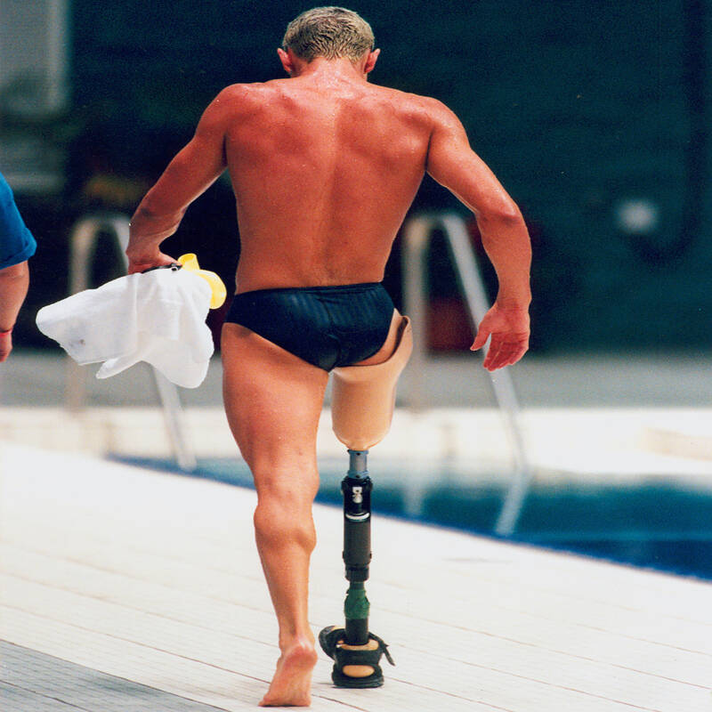 کارهایی که بعد از کاشت پای مصنوعی به روش ایمپلنت باید انجام داد.