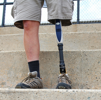 معایب کاشت پای مصنوعی به روش ایمپلنت