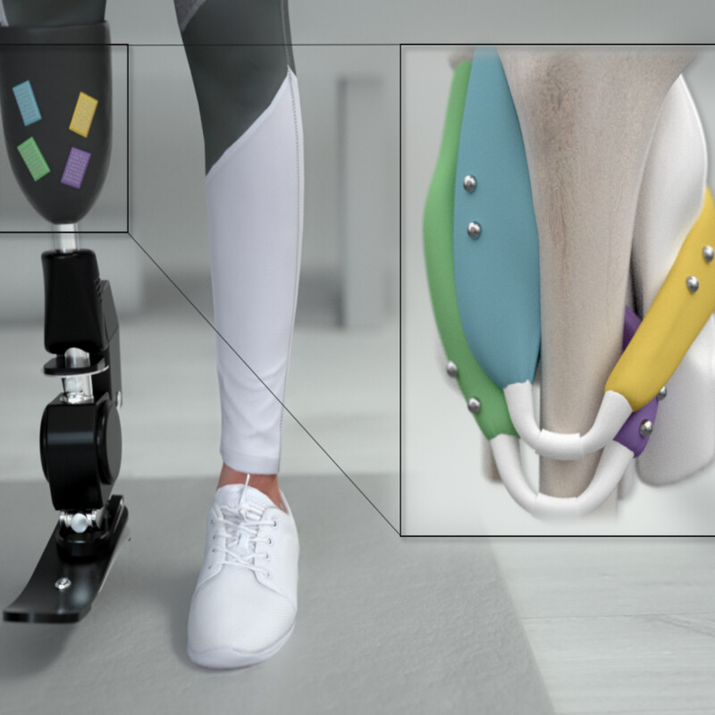 کاشت پای مصنوعی به روش ایمپلنت