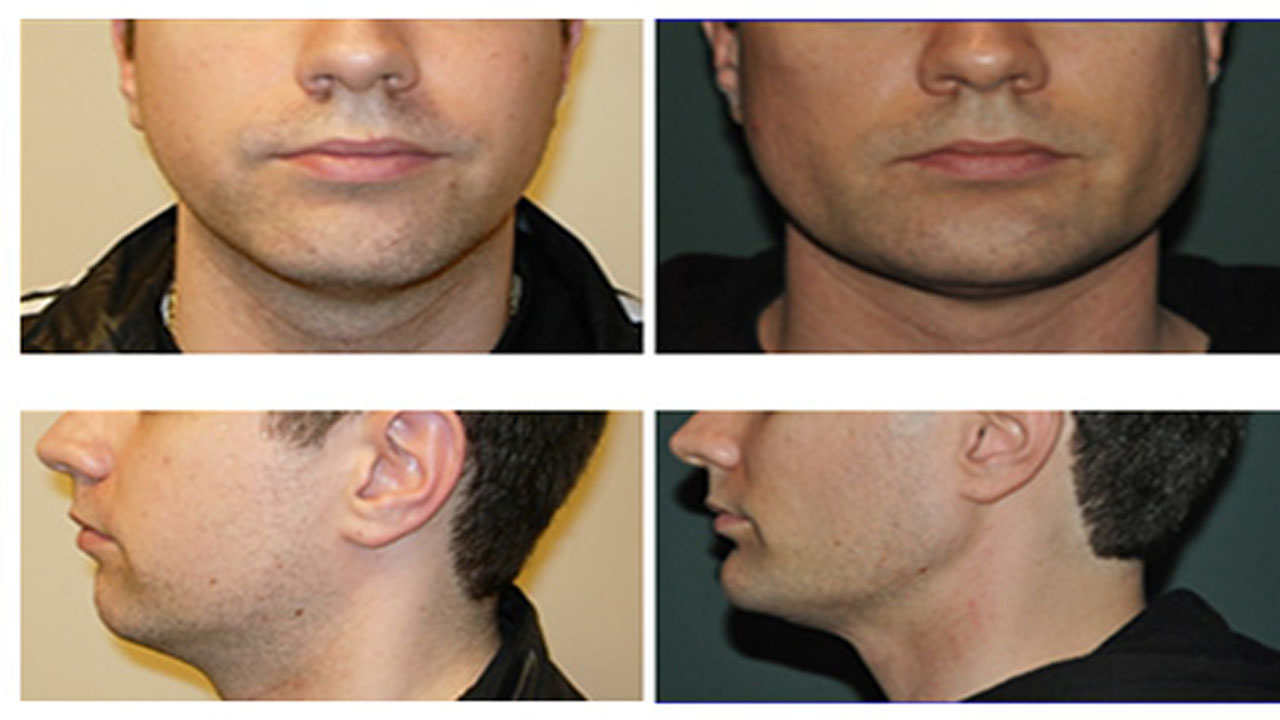 همه چیز راجب پروتز چانه و فک | متخصص پروتز چانه و فک 1 همه چیز راجب پروتز چانه و فک متخصص پروتز چانه و فک