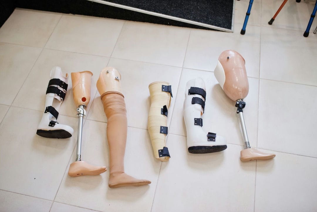 مهمترین نکات مراقبت از پای قطع شده که باید بدانید