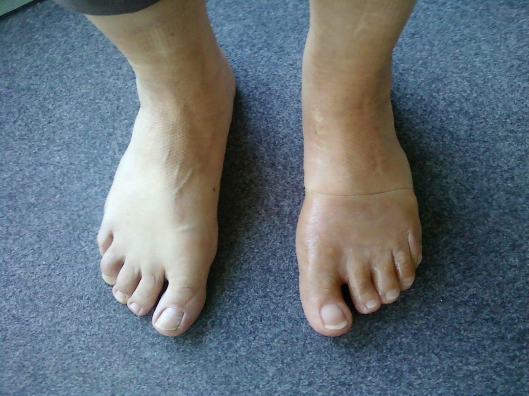 پروتز سیلیکونی چیست؟ کاربرد پروتز سیلیکونی و انواع آن