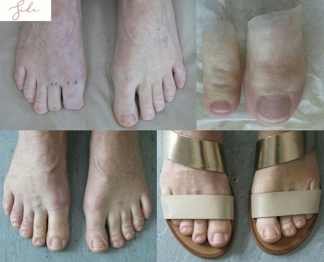 پروتز سیلیکونی چیست؟ کاربرد پروتز سیلیکونی و انواع آن 2 کاربرد پروتزهای سیلیکونی