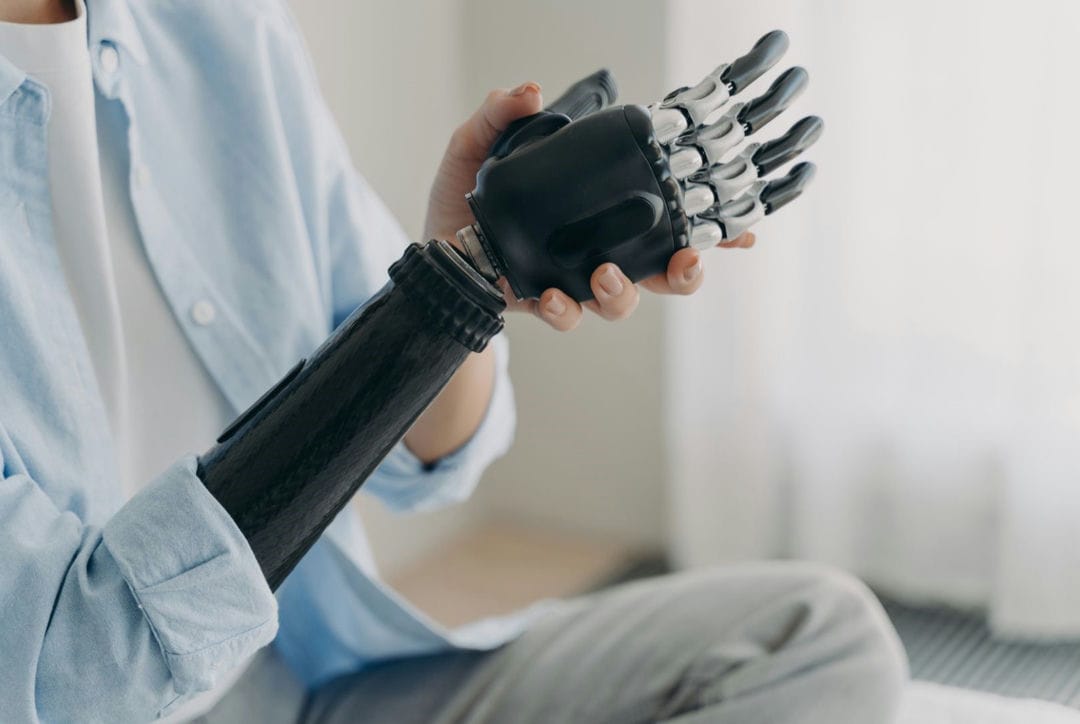 کاربرد پروتزهای مایوالکتریک