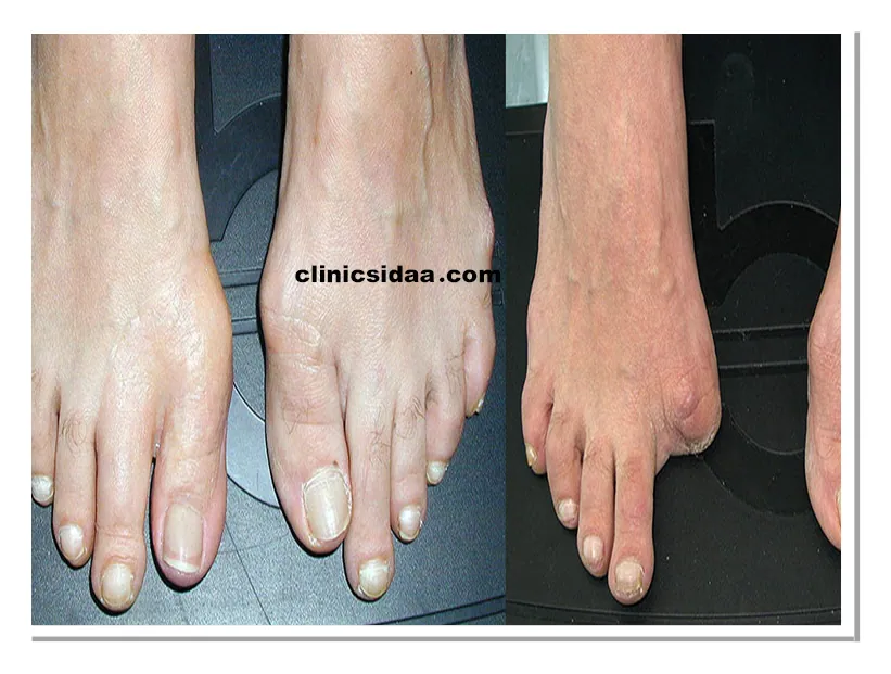 پروتز انگشت پا چگونه ساخته می شود