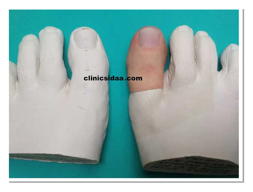 قیمت پروتز انگشت پا